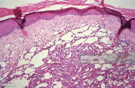 Kaposis Sarcoma Revealed In The Medium Magnification Photomicrograph