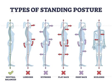 Types Of Standing Postures And Medical Back Pathology Set Outline
