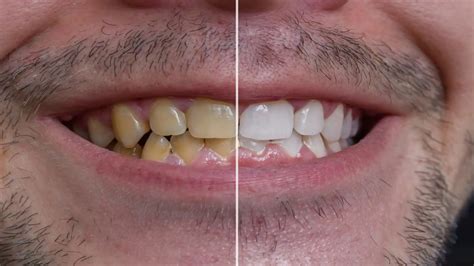 And, whether you have metal or ceramic braces, the brackets. How To Whiten Your Teeth Overnight With Braces - 10 ...