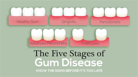 The Five Stages Of Gum Disease The Mckenzie Center Implants Periodontics
