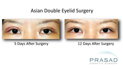 Asian Double Eyelid Surgery Nyc Amiya Prasad Md