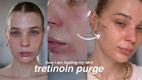 Tretinoin Ruined My Skin And How I Fixed It Tretinoin Purge Youtube