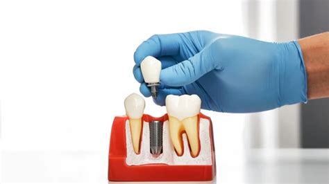 The Ultimate Guide To Understanding Dental Implants Everything You