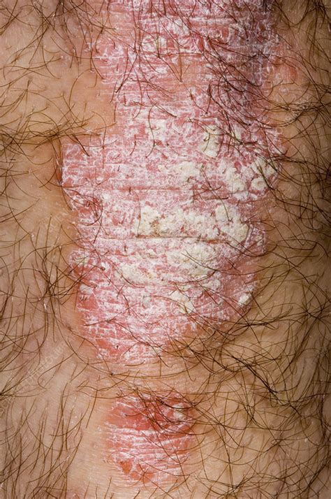 Psoriasis Skin Disorder Stock Image M2400649 Science Photo Library