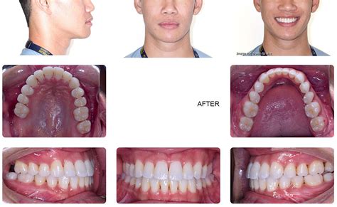 Orthodontic Smile Gallery Natalie Yang Orthodontics Vacaville Board Certified Specialist