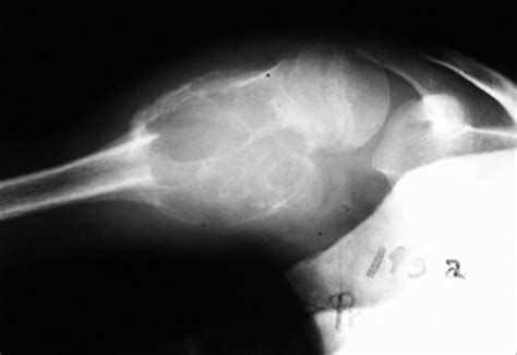 Aneurysmal Bone Cyst Radiology Case Radiology