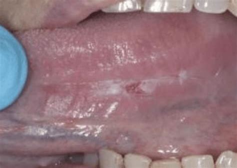 Early Oral Cancer Tongue