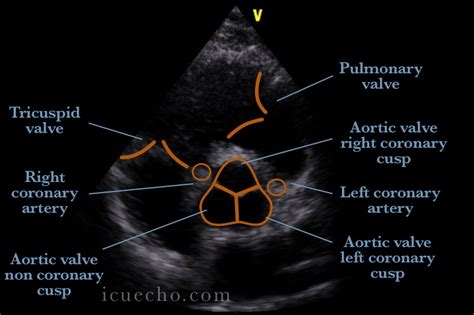 Aortic Stenosis Echocardiogram In Parasternal Short A