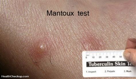 Mantoux Skin Test Procedure Results Interpretation Risks