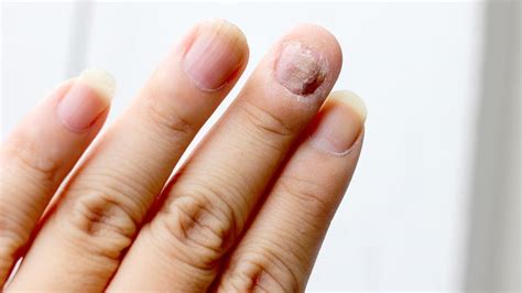 What Causes Nail Fungus Onychomycosis And Do You Treat It Goodrx