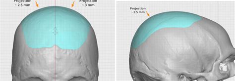 Plastic Surgery Case Study Custom Skull Implant In The Sagittal Ridge
