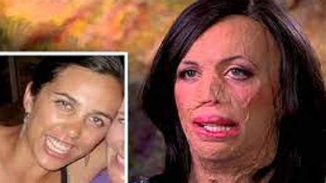 What Happened To Turia Pitt Accident Video And Before Photos Details Explained Reddit Wiki