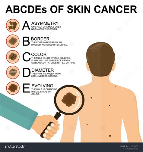 57 Melanoma Abcde Images Stock Photos Vectors Shutterstock