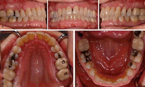 23 Chronic Periodontitis Pocket Dentistry