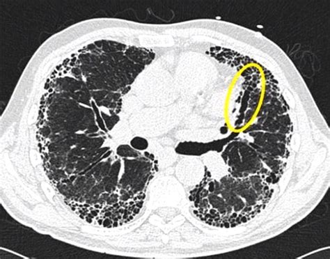 000 Usual Interstitial Pneumonia Uip Lungs