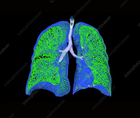 Human Lungs 3d Ct Scan Stock Image C0473061 Science Photo Library