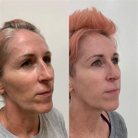 Sculptra Before And After Images Medspa In Newport Beach Ca