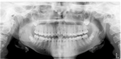 Dentigerous Cyst Dr Gs Toothpix