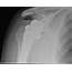 Reverse Shoulder Arthroplasty — OrthopaedicPrinciplescom
