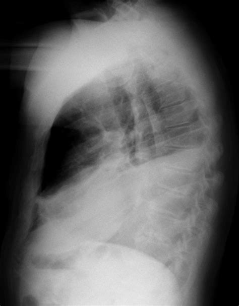 Pleural Effusion Lateral X Ray