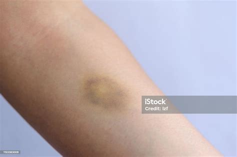 People With Bruised Arm Closeup Stock Photo Download Image Now