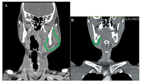 Jcm Free Full Text Minimally Invasive Intraoral Approach To