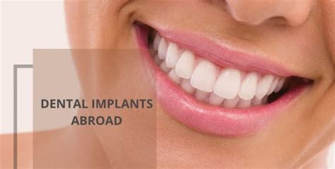 Dental Implants Abroad Comprehensive Guide 2024