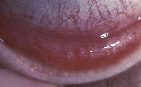 Phfi Cehj Adenovirus Ocular Manifestations