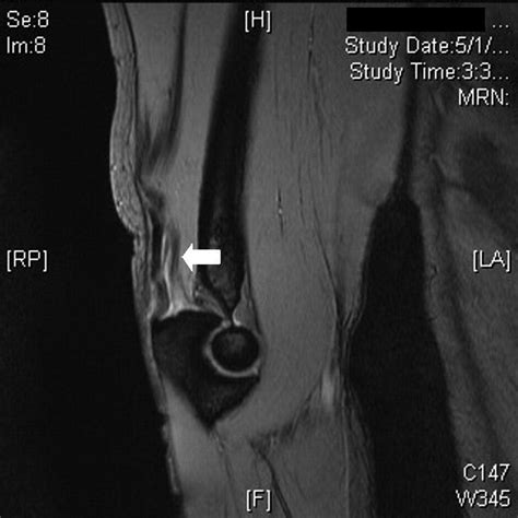 Isolated Avulsion Of The Medial Head Of The Triceps Tendon An Anatomic