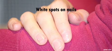 White Spots On Nails Causes Treatments And Prevention Sehat