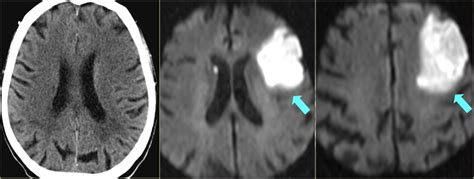 The Radiology Assistant Brain Ischemia Imaging In Acute Stroke