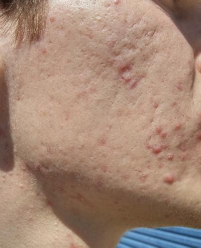 Bad Acne Scars After Accutane Treatment Scar Treatments