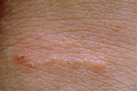 Scabies Pictures Of Rash And Mites Symptoms Treatment