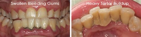 Hardened Plaque On Gums Dental Plaque What It Is What Causes It And How To Get Rid Of I We