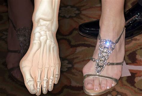 Celebrities With Hammer Toes 11 טקסטיל Bunion Shoes Hammer Toe