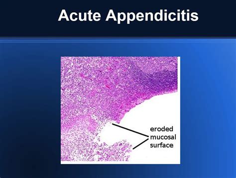 Pathology Of Acute Appendicitis Its Etiology Morphology Gross