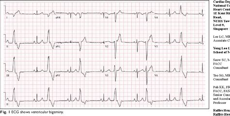 Figure 1 From Managing Ventricular Ectopics Are Ventr