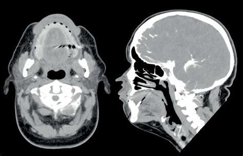 Sagittal And Axial Sections Of Ct Cisternography A Axial And B