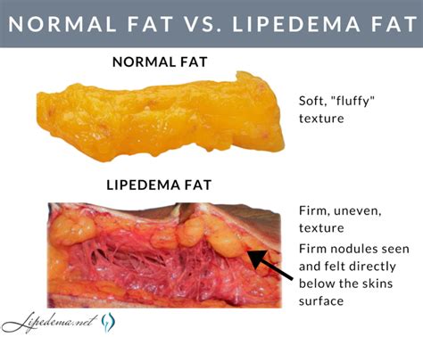 Learn About Lipedema Nodules And How To Determine If You Have Them