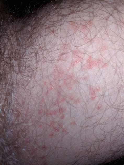 Fungal Rash On Inner Thigh