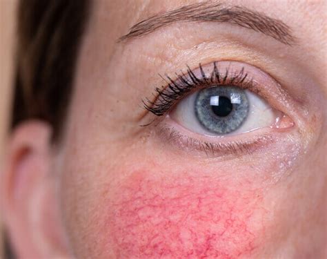 Redness And Sensitivity Skin Concern