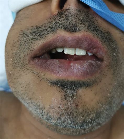 Extraoral Photograph Of The Patient Showing Swelling On Right Side Of