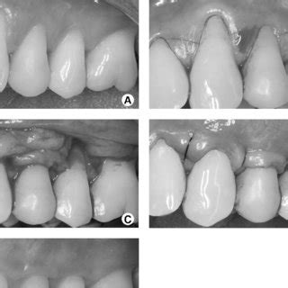 PDF Palatal Harvesting Technique Modification For Better Control Of