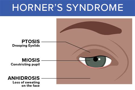 Horners Syndrome All About Vision