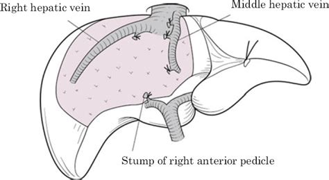 Sectionectomy Of The Liver Yamanaka 2012 Journal Of Hepato