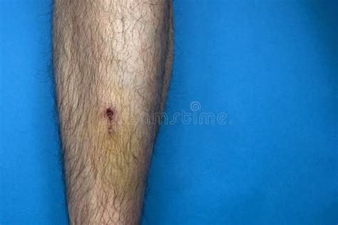 Bruise And Clotted Blood On The Leg Of A Young Man Stock Image Image