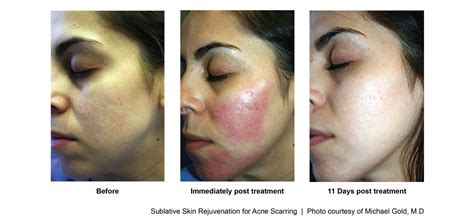 Sublative Laser Skin Resurfacing™ Lipstick Empire Laserspa