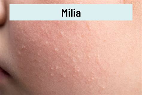 White Bumps On Face Milia And 9 Other Causes
