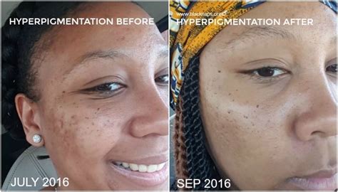My Hyperpigmentation And All Natural Skin Care Regimen Natural Beauty