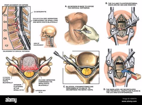 C4 5 And C5 6 Anterior Cervical Discectomy And Fusion Stock Photo